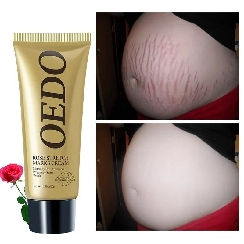 Rose Removes Stretch Mark Cream